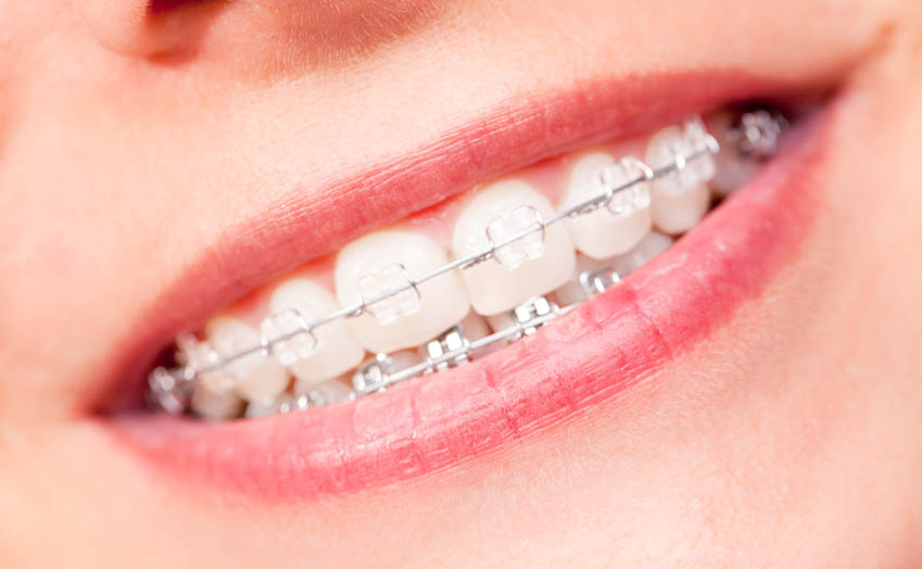 Keramik-Brackets sind weniger auffällig als Metall-Brackets Welche Nachteile hat eine übliche KFO-Behandlung? Wenn die KFO-Behandlung mit festsitzenden Apparaturen aus sog. Brackets und Drahtbögen (siehe Foto) durchgeführt wird, ist das für Erwachsene aus zwei Gründen meistens unangenehm: Die kieferorthopädischen Apparaturen sind für Andere deutlich sichtbar